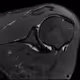 Labral Tear