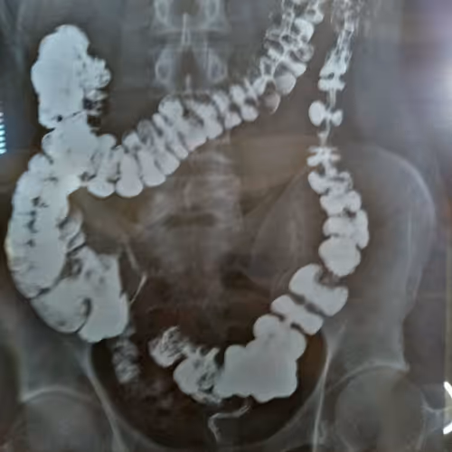 ирригоскопия