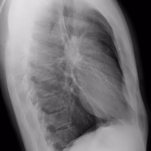 MyChestPainSide