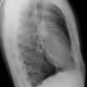 MyChestPainSide