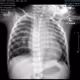 chest xray