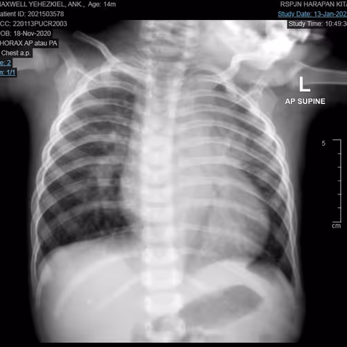 chest xray
