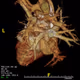 CT of chest anomaly