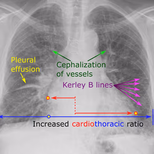 CXR