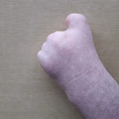 Left Hand Metacarpal Amputee