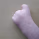 Left Hand Metacarpal Amputee