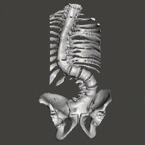 Scoliosis-Spine with graceful movements