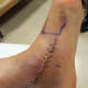 ankle reconstruction