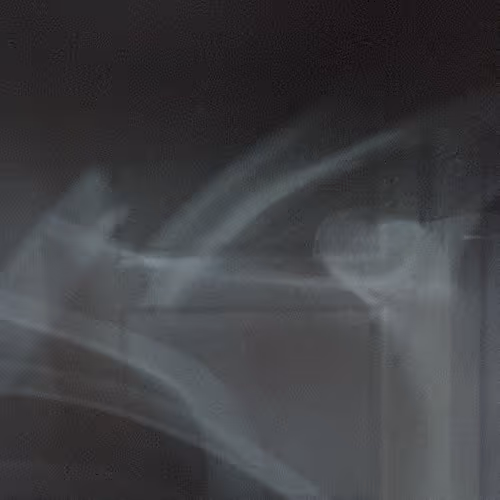 The story of the fracture and healing of my collarbone.