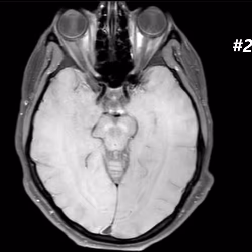 my brain after a stroke