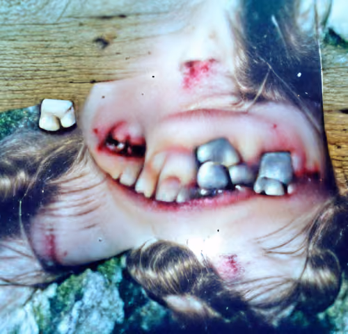 I fell and was then known as the little girl with the grey front tooth.