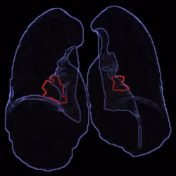 Covid19Lungs #106