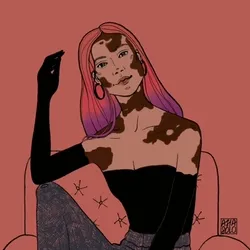 Vitiligo