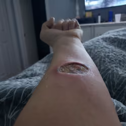 Tattoo Removal 