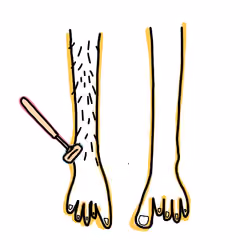 jaundice