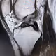 Anterior cruciate ligament rupture