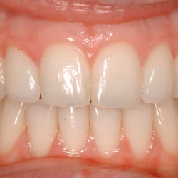 Retracted Smile