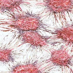 Vaginal Cancer Cells