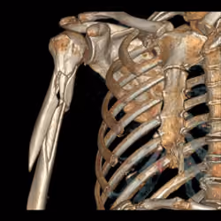 Broken Arm, Ski Accident — French Alps, February 2021
