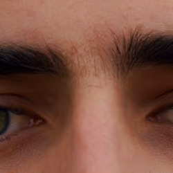 Coloboma