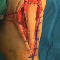 Achilles Tendon Repair