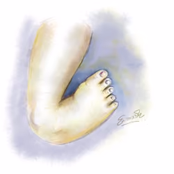 Clubfoot 