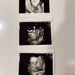  I 'lived' inside my mum's abdomen