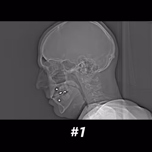 my brain after a stroke