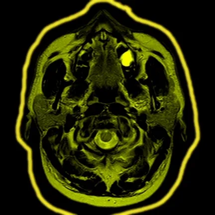 Xradiare