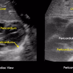 US - Cardiac ultrasound, pericardial effusion