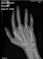 Right Hand Multiple Fracture Series