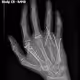 Right Hand Multiple Fracture Series