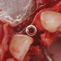 Dental implant removal surgery #3