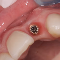 Dental implant removal surgery #2