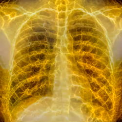 XR Chest Private Study #498