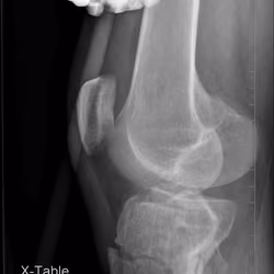 External Fixator Side