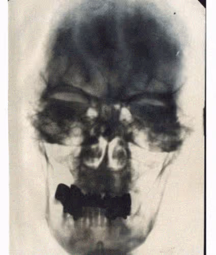 Hitler's Skull Head X-Ray