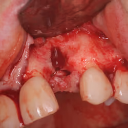 Dental implant removal surgery #4
