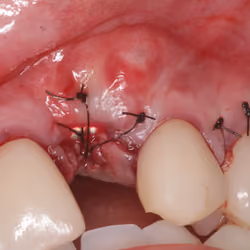 Dental implant removal surgery #5