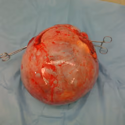 Tumor abdominal