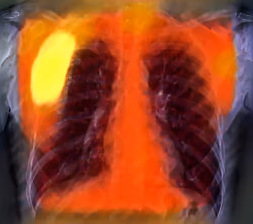 XR Chest #12