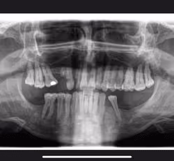 X-Ray