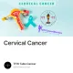 Cervical Cancer