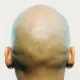 Bald_Burner_Awoo
