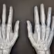 Aradiograft