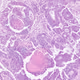 AdenoCA
