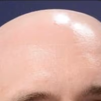 BALD