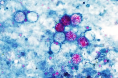 CYCLOSPORA