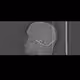 Tomography